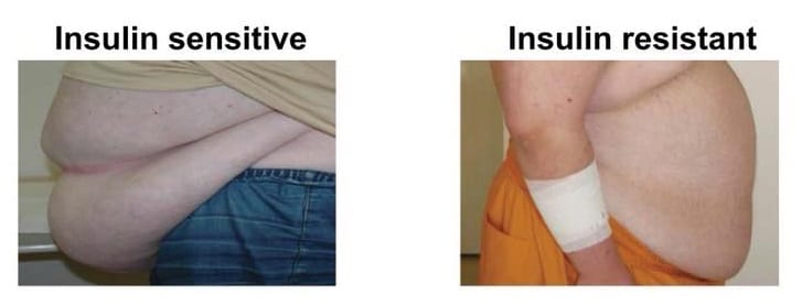 subcutaneous vs visceral fat